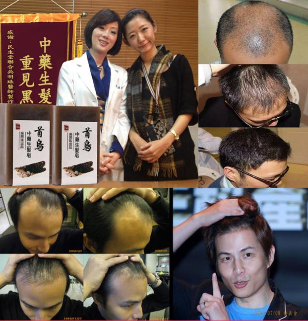 【最後一波現貨!!】【憲哥脫髮救星! 】【拯救地中海】【10天就見效! 1個療程頭髮增長1萬根】台灣吳明珠中醫師最新研發山葵何首烏中藥增發皂【雄性禿】【遺傳禿】【溢脂性脫髮】都有效【男女通用,拯救頭髮】 【最後一波現貨!!】【憲哥脫髮救星! 】【拯救地中海】【10天就見效! 1個療程頭髮增長1萬根】台灣吳明珠中醫師最新研發山葵何首烏中藥增發皂【雄性禿】【遺傳禿】【溢脂性脫髮】都有效【男女通用,拯救頭髮】