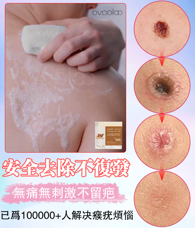 山羊奶去疣精油皂無需手術 衹需一洗輕鬆解决問題